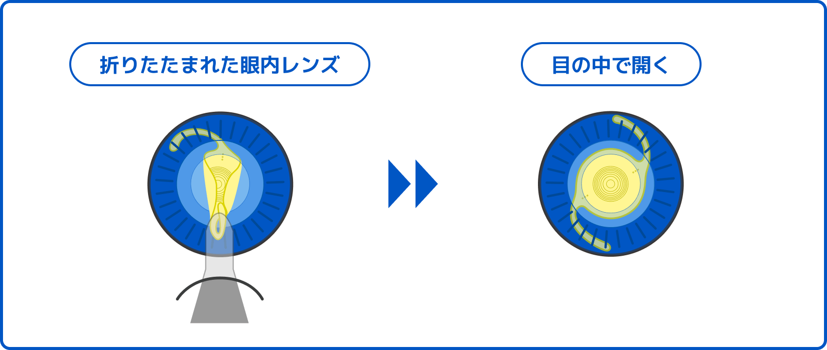 折りたたまれた眼内レンズ　目の中で開く